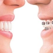 Invisalign ortodoncia invisible